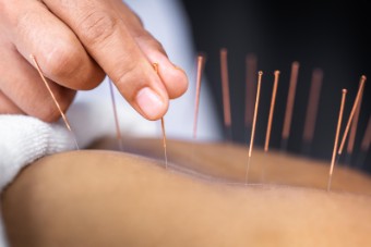 Acupuncture at Ananta Health